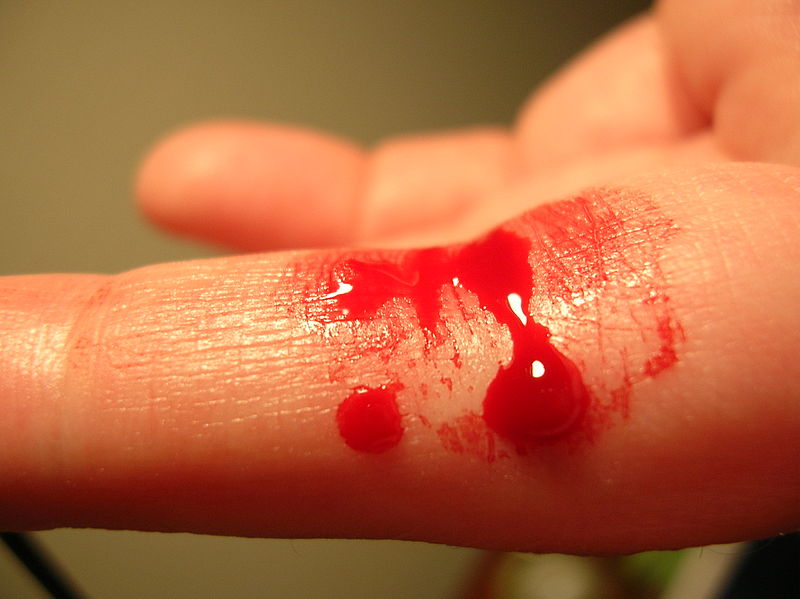 wikibleedingfinger.jpg