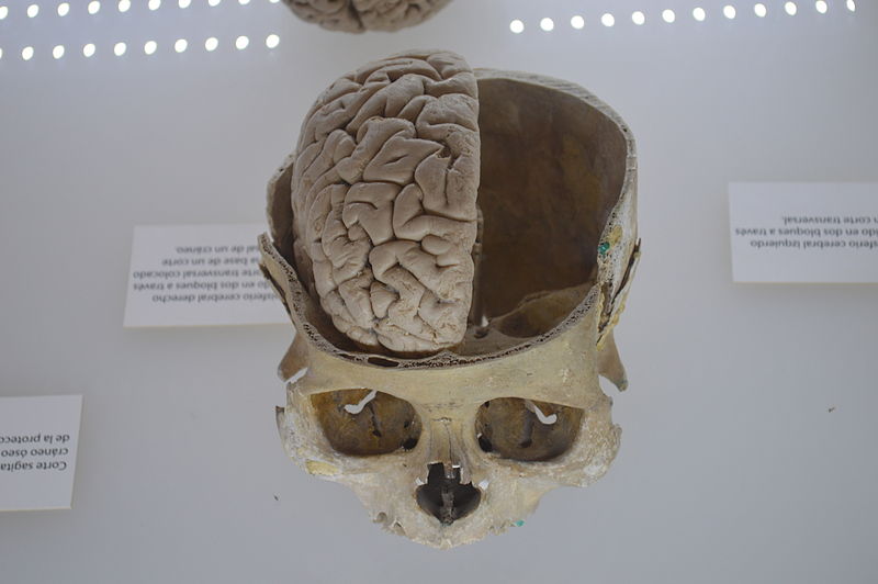 wikihalfbraininskull.JPG