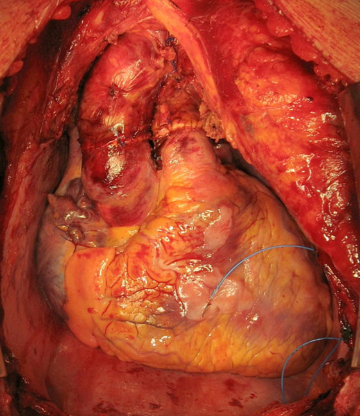 wikihearttransplant.JPG
